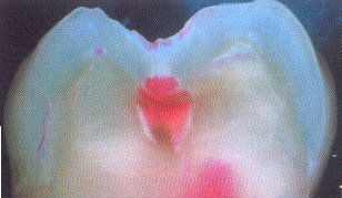 Dental Care Kids Pediatric & Orthodontic dentistry - Diagodent cross-section