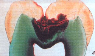Dental Care Kids Pediatric & Orthodontic dentistry - Diagodent cross-section with cavity