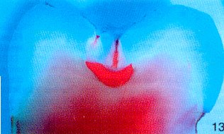 Dental Care Kids Pediatric and Orthodontic dentistry - caries detection