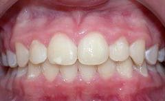 Braces after photo #2b