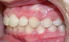 Braces after photo #2c