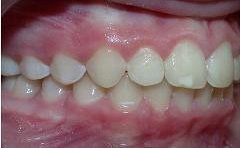 Braces after photo #2d
