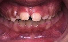 Braces before photo #2b