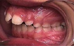 Braces before photo #2c