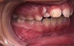 Braces before photo #2d