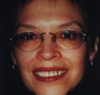 Porcelain veneers before photo #2a