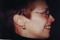 Porcelain veneers before photo #2f