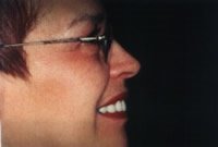 Porcelain veneers after photo #2f