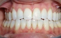 Invisalign after photo #1b