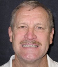 Invisalign before photo #2a
