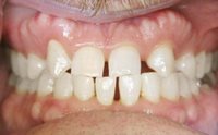 Invisalign before photo #2b