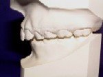 Class II Malocclusion