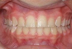 Braces after photo #3b
