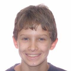 Braces after photo #3a