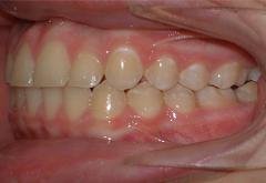 Braces after photo #3c