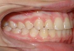 Braces after photo #3d