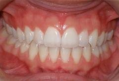 Braces after photo #1b