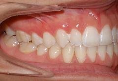 Braces after photo #1d