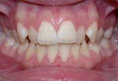 Braces before photo #1b