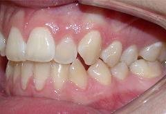 Braces before photo #1c