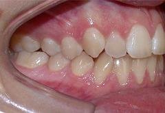 Braces before photo #1d