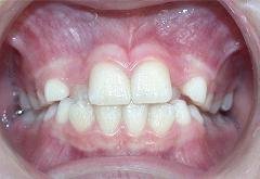Braces before photo #3b