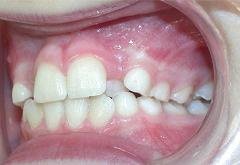Braces before photo #3c