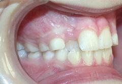 Braces before photo #3d