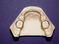 Lower lingual arch image