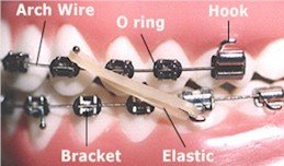 Orthodontic terms image