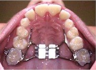 Palatal Widening Appliance