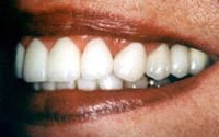 Porcelain veneers after photo #2d