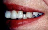 Porcelain veneers before photo #2d