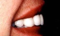 Porcelain veneers after photo #2e