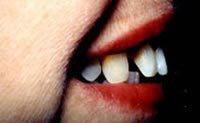 Porcelain veneers before photo #2e