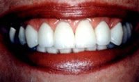 Porcelain veneers after photo #2b