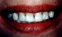Porcelain veneers before photo #2b