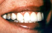 Porcelain veneers after photo #2c