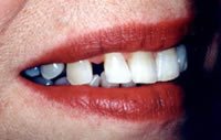 Porcelain veneers before photo #2c