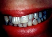 Porcelain veneers before photo #1a