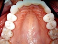 Porcelain veneers after photo #1e