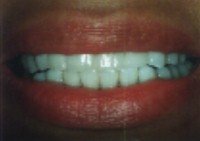 Porcelain veneers after photo #1a