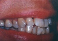 Porcelain veneers before photo #1b