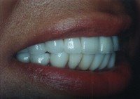 Porcelain veneers after photo #1b