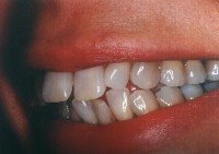 Porcelain veneers before photo #1c