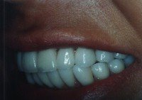 Porcelain veneers after photo #1c