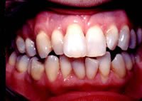 Porcelain veneers before photo #1d