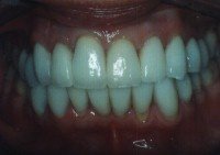 Porcelain veneers after photo #1d