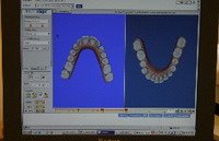 teeth straigntening