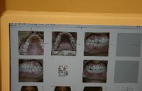 teeth straightening